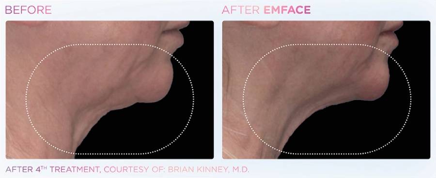 Before and after photo showing a woman's neck with sagging, wrinkled skin before and firmer, more lifted skin after Emface treatment.