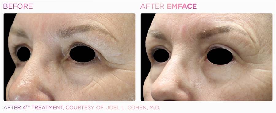 Before and after photos showing a woman's eyes with lines and wrinkles and hooded eyelids before and firmer, tighter, less wrinkled skin around the eyes after Emface treatment.
